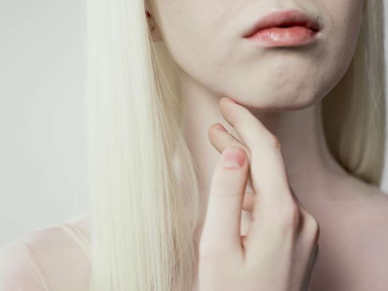 Frau mit Albinismus